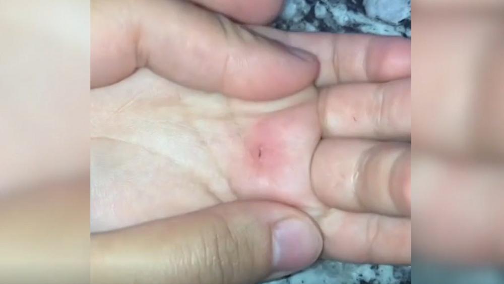 Ohne Nadel So Geht Ein Splitter Ganz Leicht Aus Der Haut