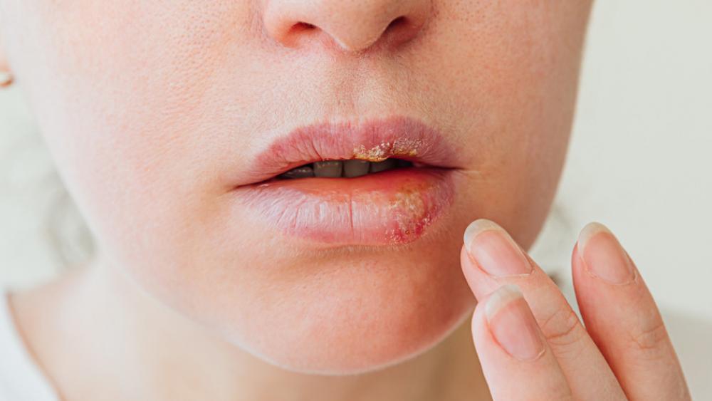 Lippenherpes Diese Hausmittel helfen!