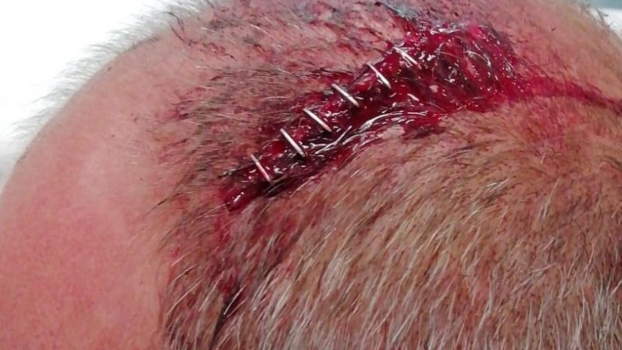 Überfallener Meraner klagt an: „Wer läuft denn bitte mit einem Knüppel ...