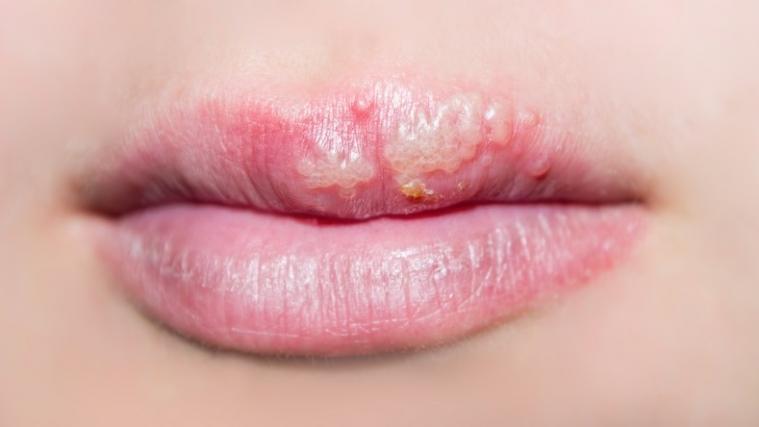 Fieberblase oder auch Herpes