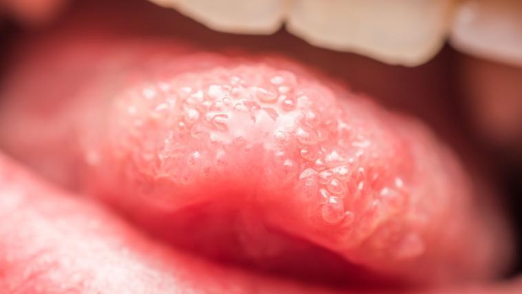 Ein Drittel der Coronavirus-Infizierten in Italien beklagen Störungen des Geruchs- und Geschmackssinns.