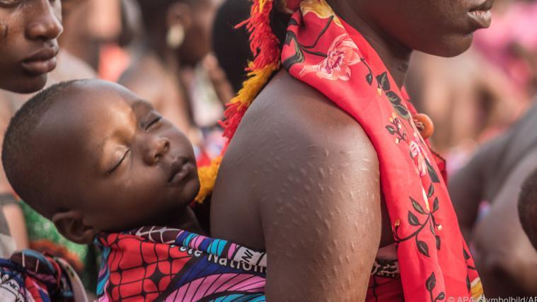 Vor allem in Indien und in Subsahara-Afrika starben 2019 viele Kinder an der hohen Luftverschmutzung.